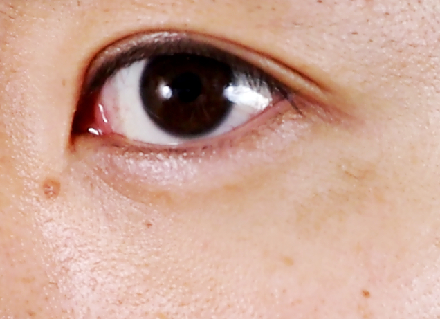 三週間目のシミ左目