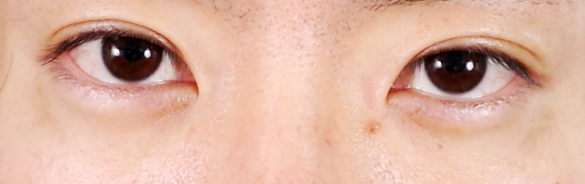 四週間目のシミの正面