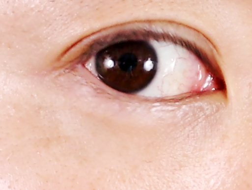 四週間目のシミ右目