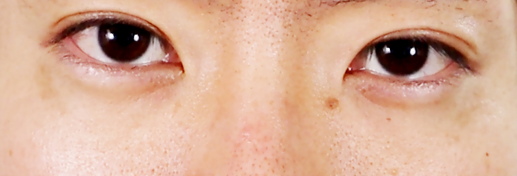 六週間目のシミの状態