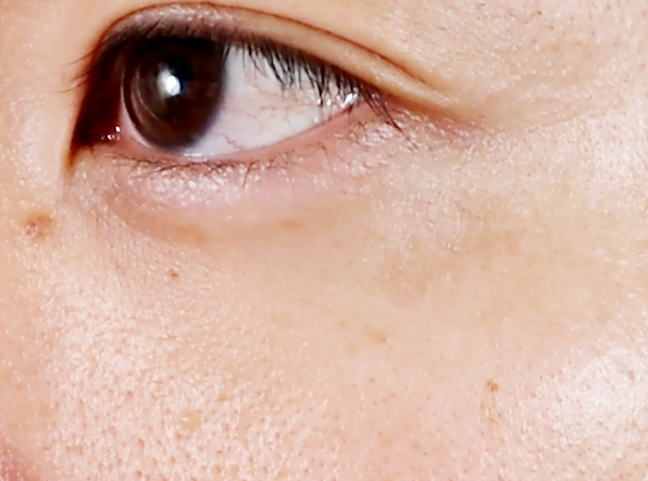 六週間目のシミの状態