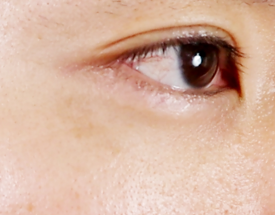 六週間目のシミの状態