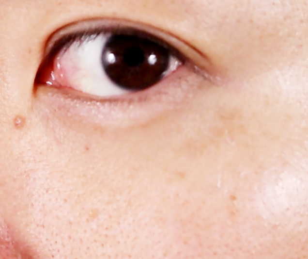 八週間目のシミの状態