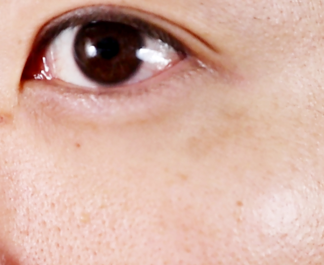 9週間目のシミの状態